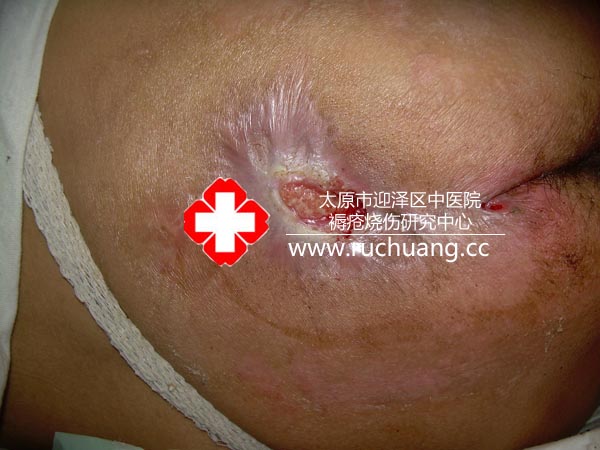 褥疮治疗后